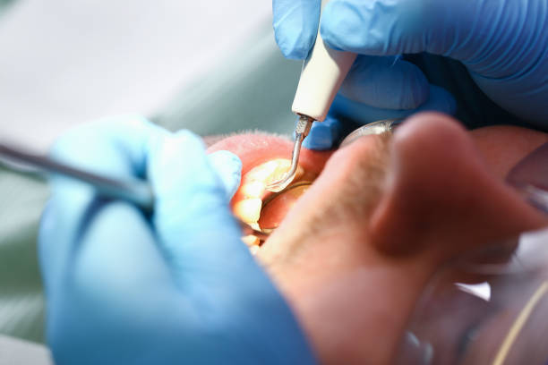 Best Urgent Care for Lost Fillings or Crowns in St Louis, MO